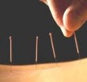 Image of Acupuncture