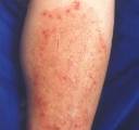 Image of leg with eczma